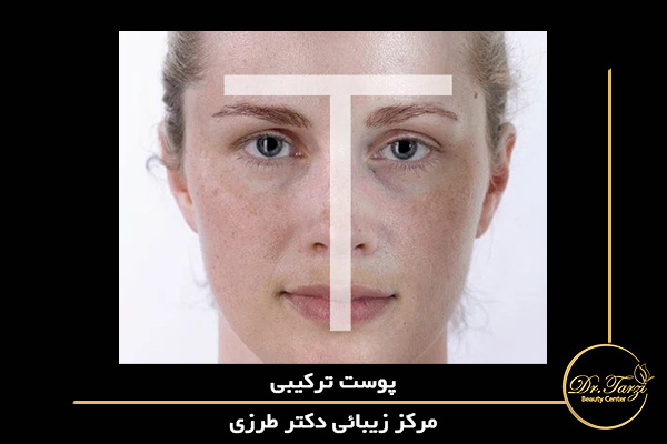 T-Zone چرب (پیشانی، بینی و چانه) و گونه های خشک کن به اصطلاح پوست مختلط را نشان می دهد.