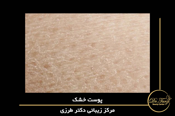 سفتی و احساس خشن شدن پوست اغلب نشان دهنده خشکی پوست است.