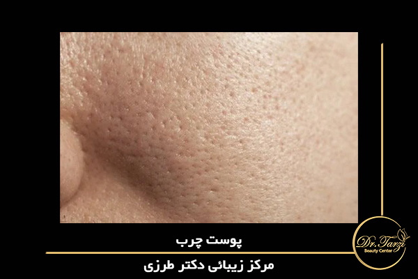 پوست چرب را می توان با منافذ بزرگ و قابل مشاهده مشخص کرد.
