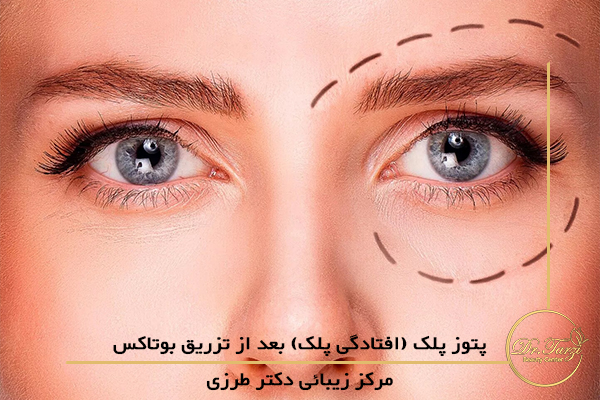 افتادگی پلک بعد از تزریق بوتاکس