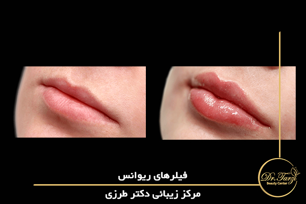 فیلر ریوانس