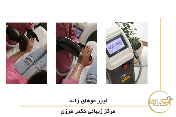 لیزر موهای زائد