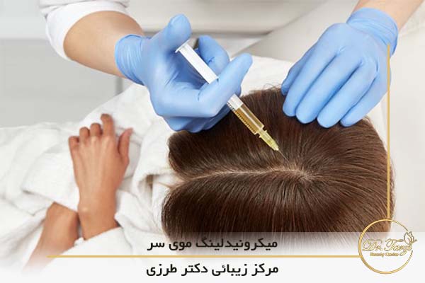میکرونیدلینگ موی سر