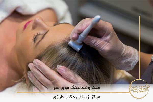 مزایای میکرونیدلینگ موی سر