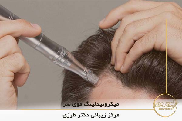 آشنایی با عوارض میکرونیدلینگ موی سر  