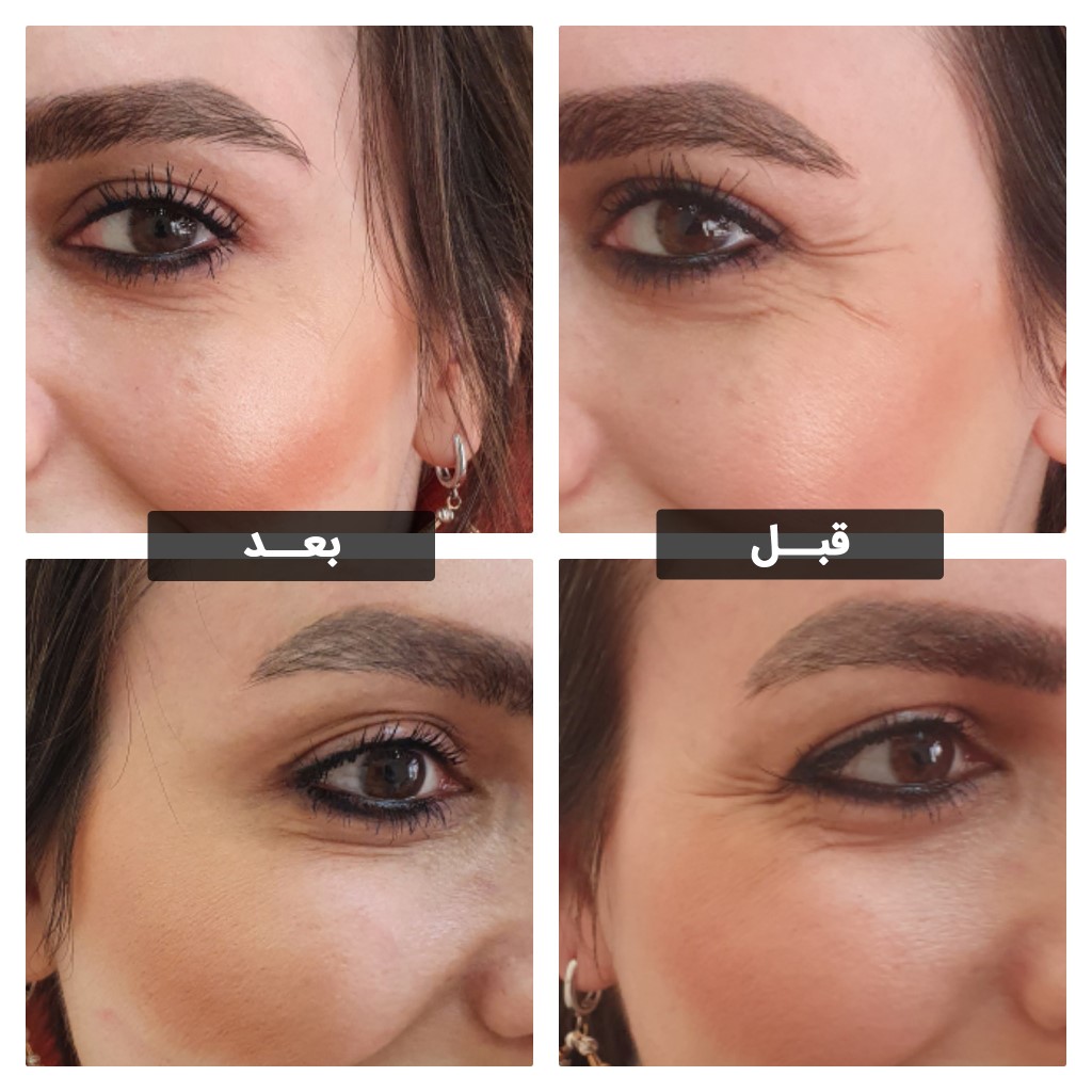 تزریق بوتاکس