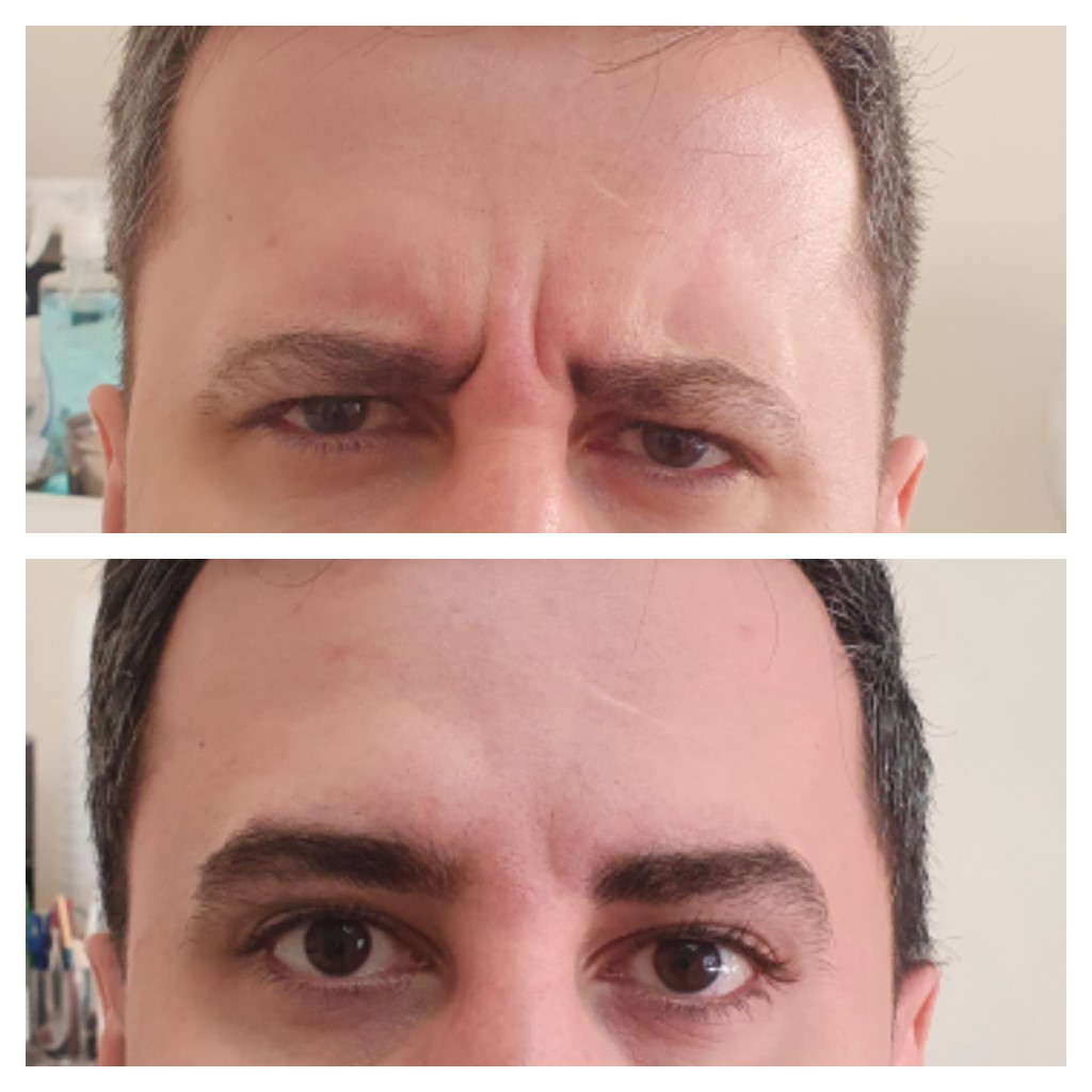 تزریق بوتاکس