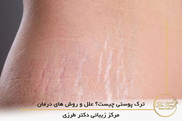 ترک پوستی چیست؟ علل و روش های درمان