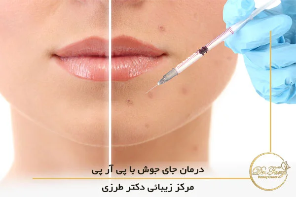 درمان اسکار آکنه (جای جوش) با پی آر پی