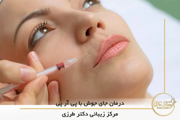 درمان اسکار آکنه (جای جوش) با پی آر پی