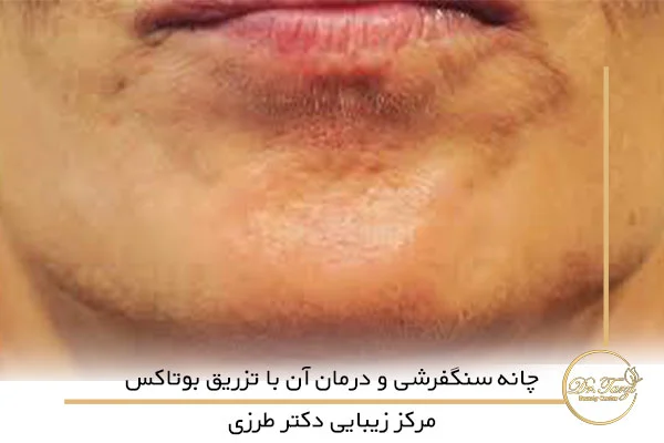 چانه سنگفرشی و درمان آن با تزریق بوتاکس
