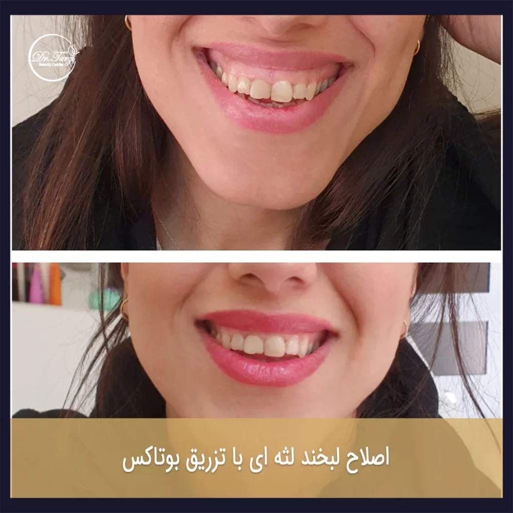لبخند لثه‌ای: راهکارهای موثر در درمان با تزریق بوتاکس