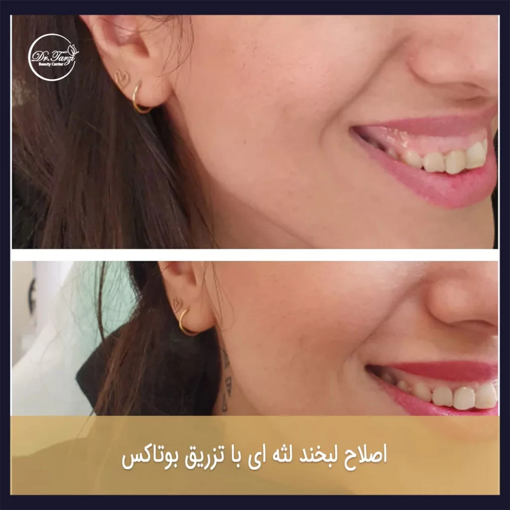 لبخند لثه‌ای: راهکارهای موثر در درمان با تزریق بوتاکس