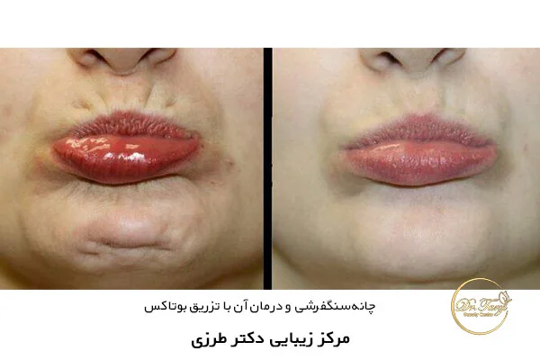 چانه سنگفرشی و درمان آن با تزریق بوتاکس