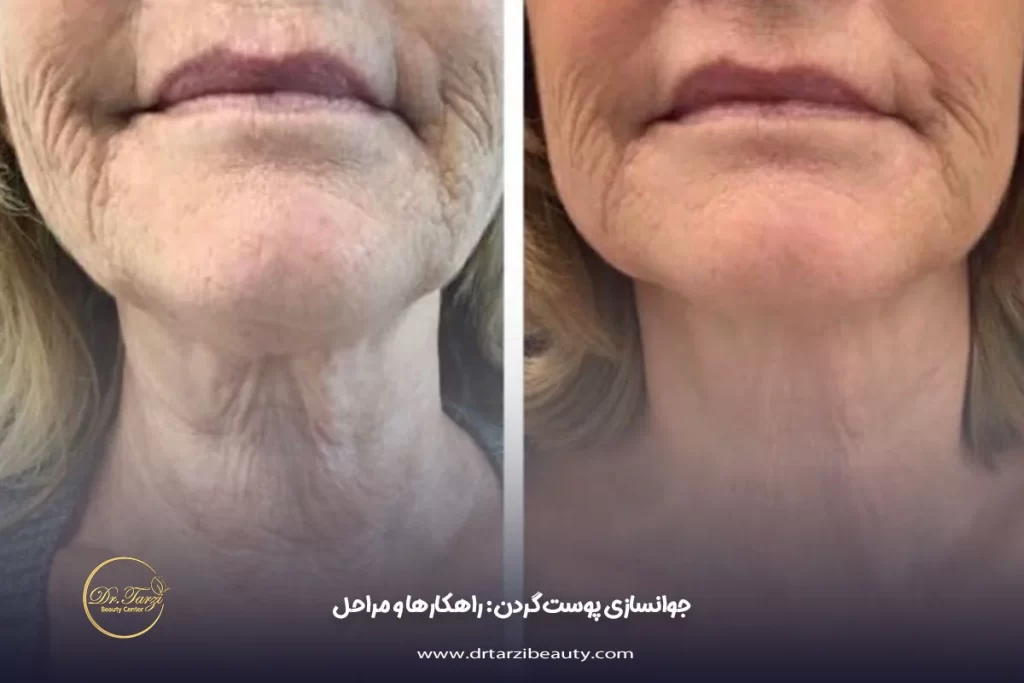 جوانسازی پوست گردن