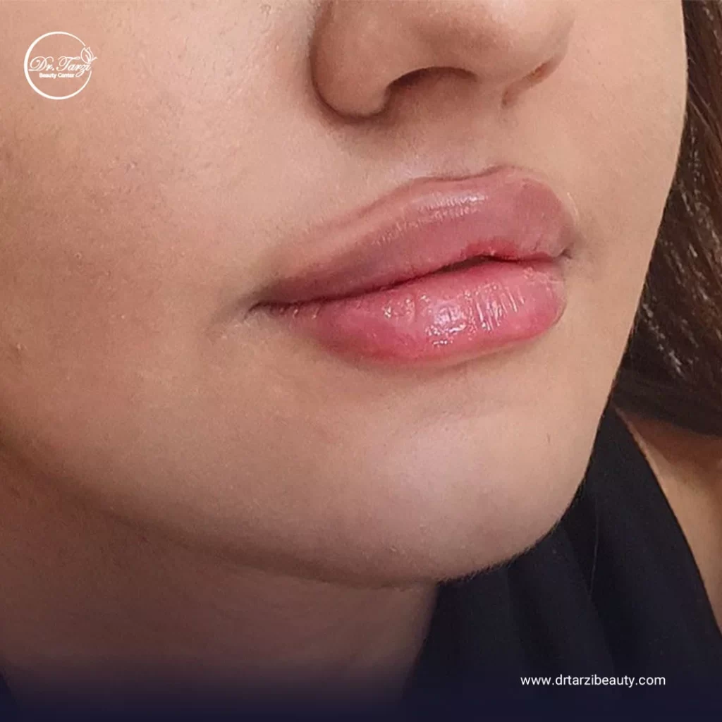 تزریق ژل لب روسی