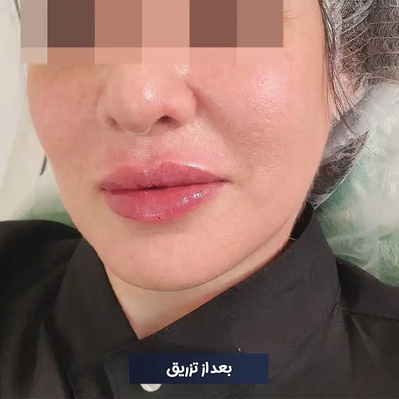 تزریق ژل لب روسی دکتر طرزی