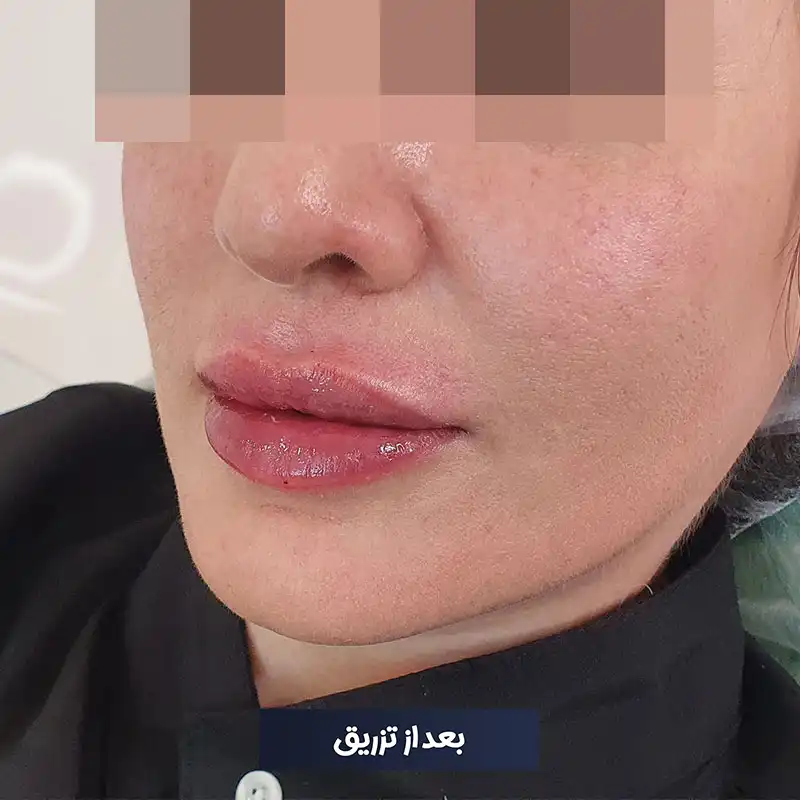 تزریق ژل لب روسی دکتر طرزی