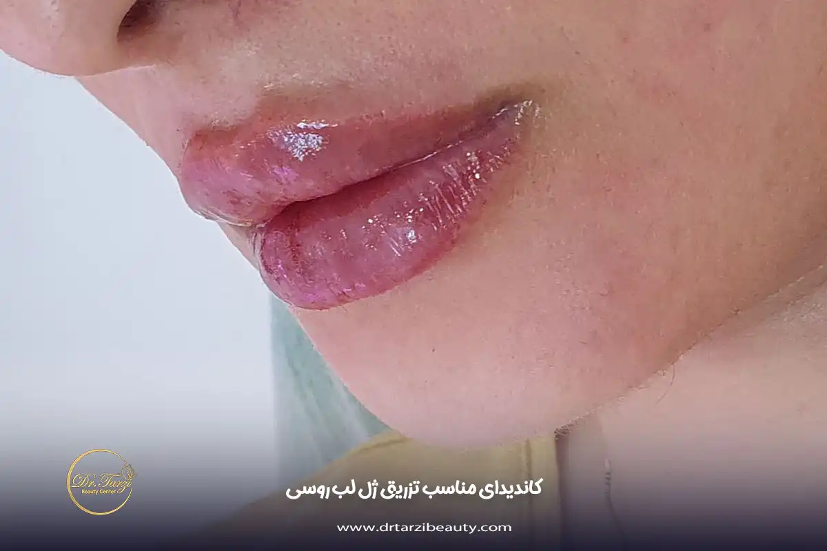 کاندیدای مناسب تزریق ژل لب روسی