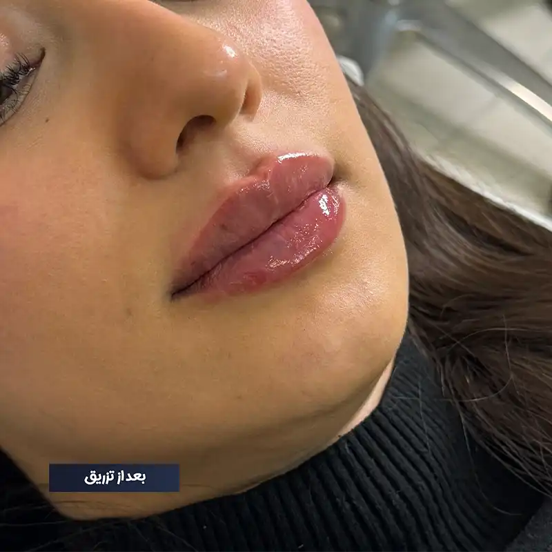 نمونه تزریق ژل لب روسی