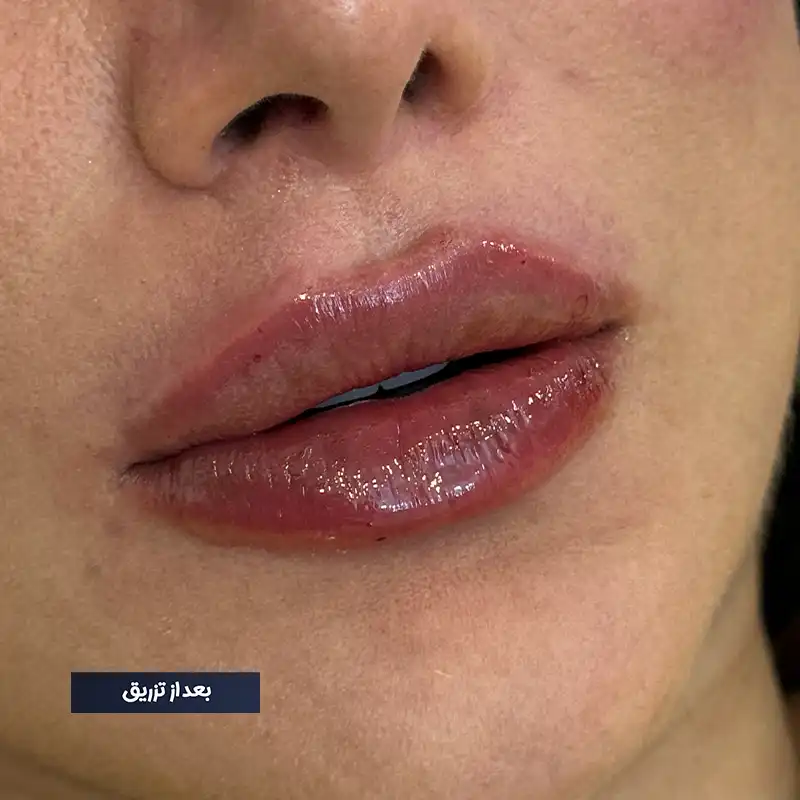 نمونه تزریق ژل لب روسی