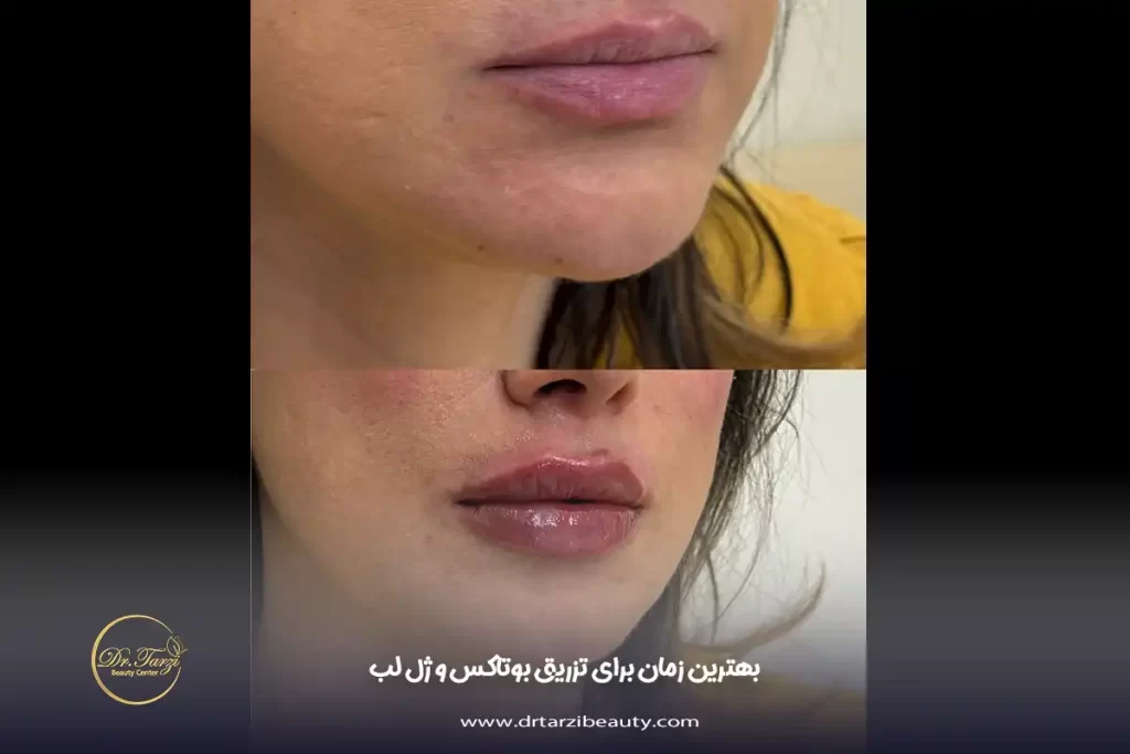 تزریق بوتاکس و ژل لب