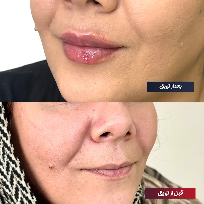 نمونه تزریق ژل لب روسی