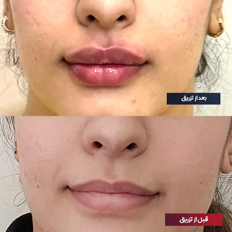 نمونه تزریق ژل لب روسی