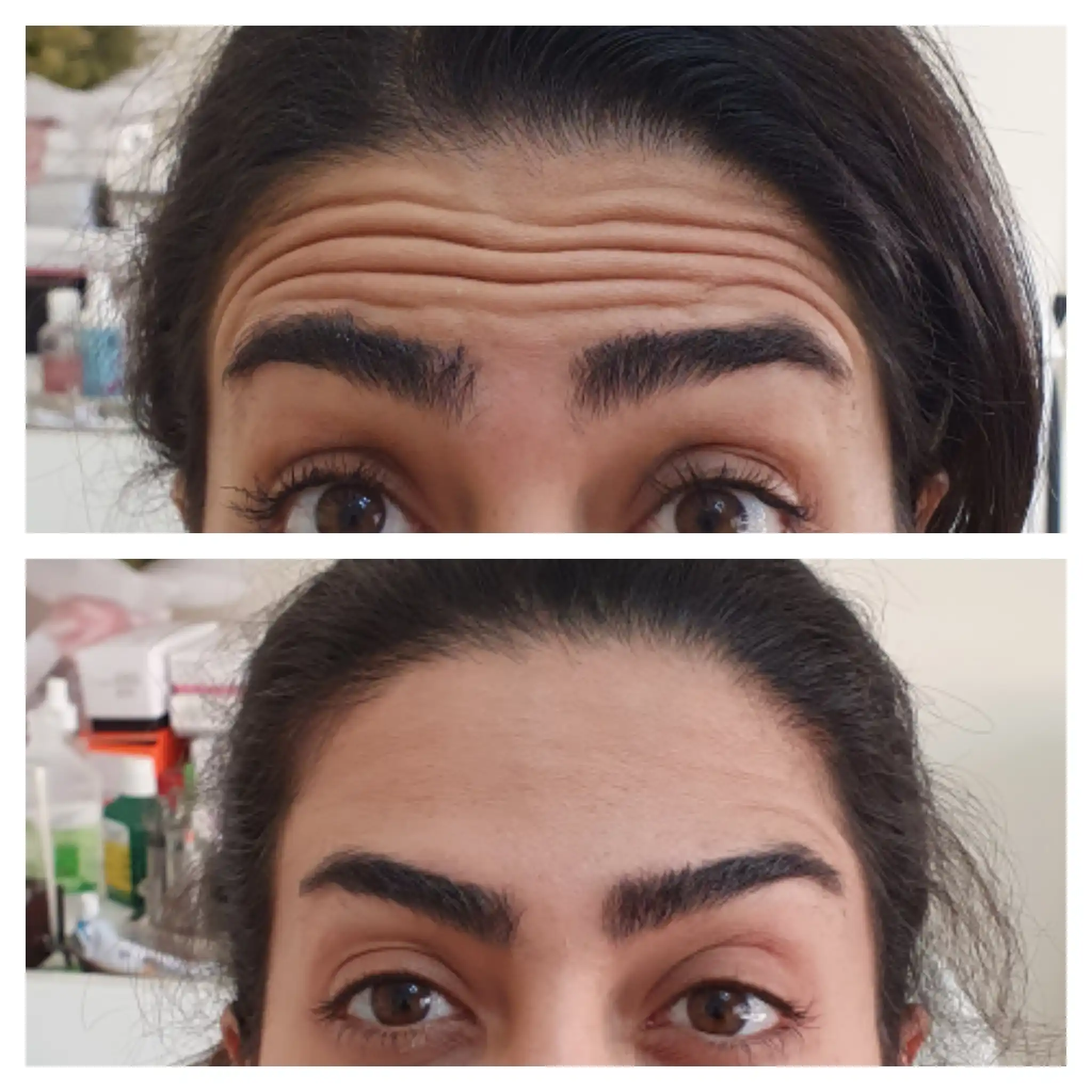 نمونه تزریق بوتاکس صورت