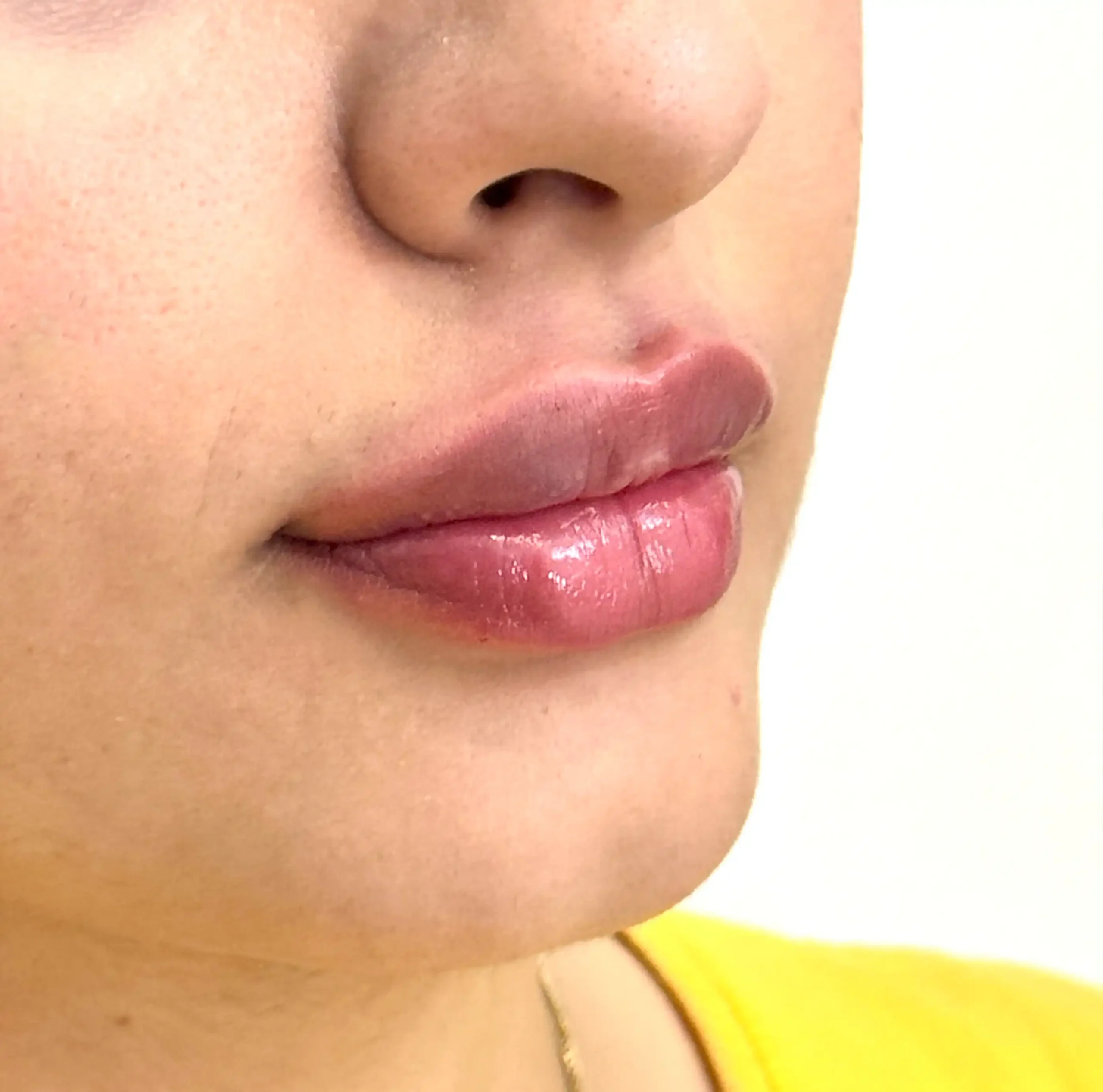 نمونه تزریق فیلر لب دکتر طرزی