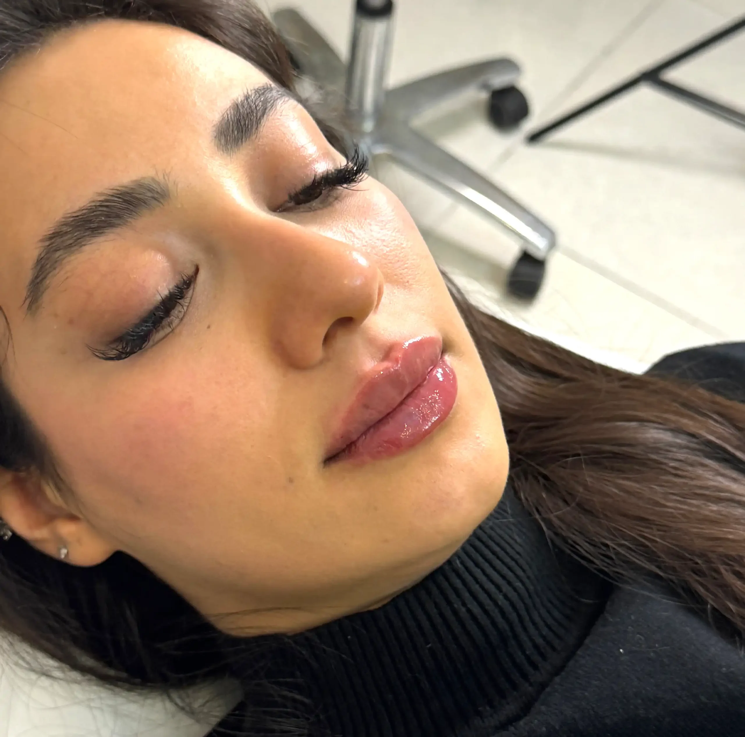 نمونه تزریق فیلر لب دکتر طرزی