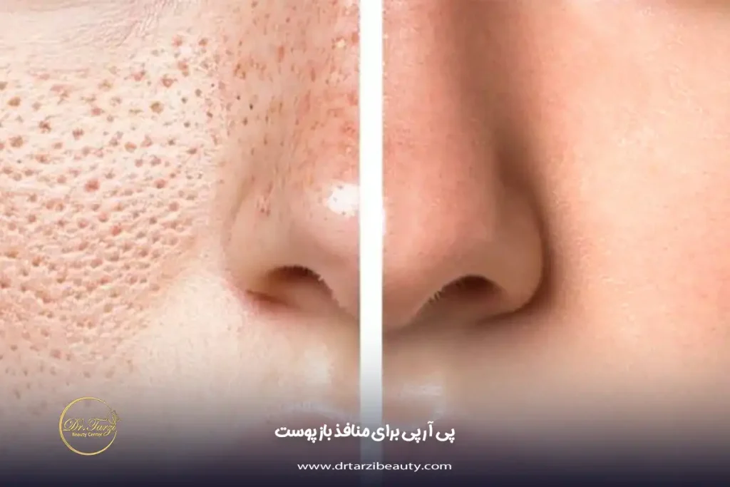 پی آر پی برای منافذ باز پوست