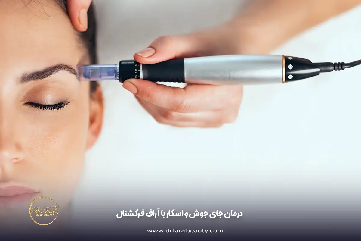 درمان جای جوش و اسکار با آراف فرکشنال