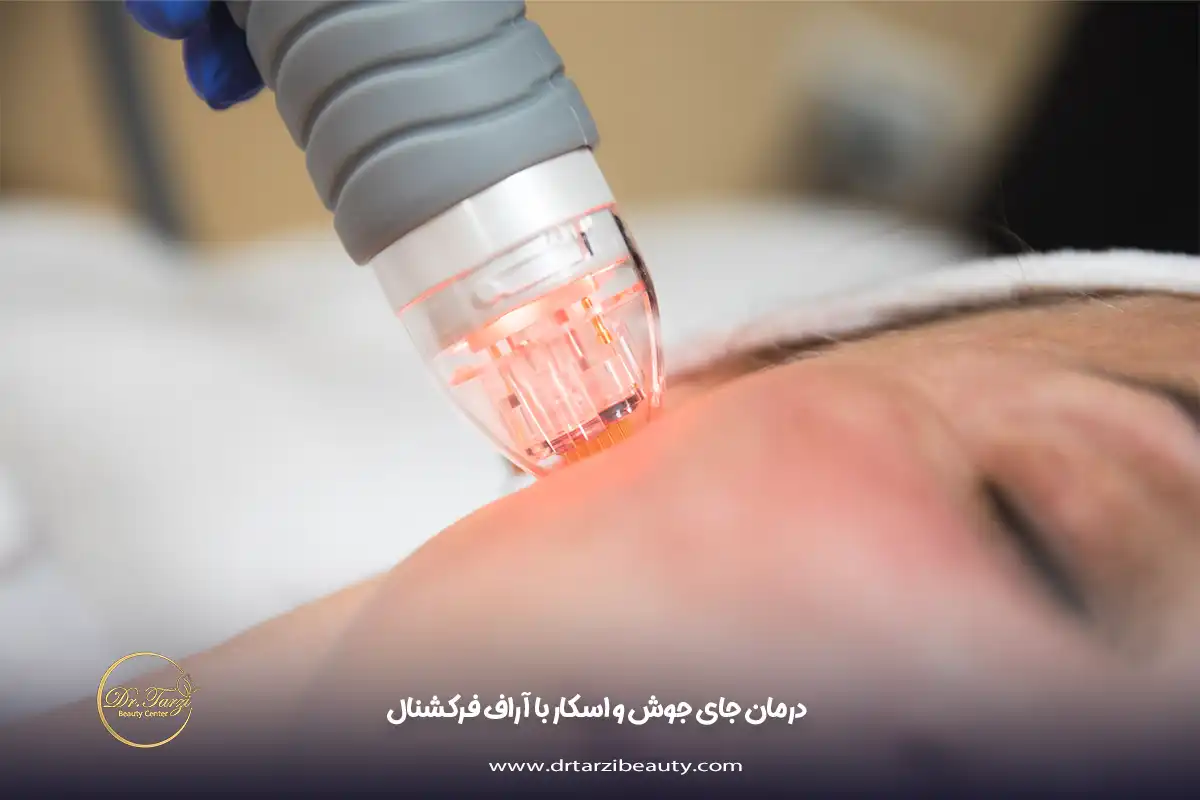 درمان جای جوش و اسکار با آراف فرکشنال