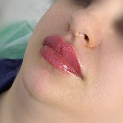 فیلر لب طبیعی
